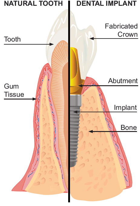 natural tooth vs dental implant